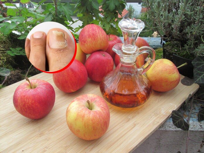 Use vinagre de maçã para tratar fungos e micose